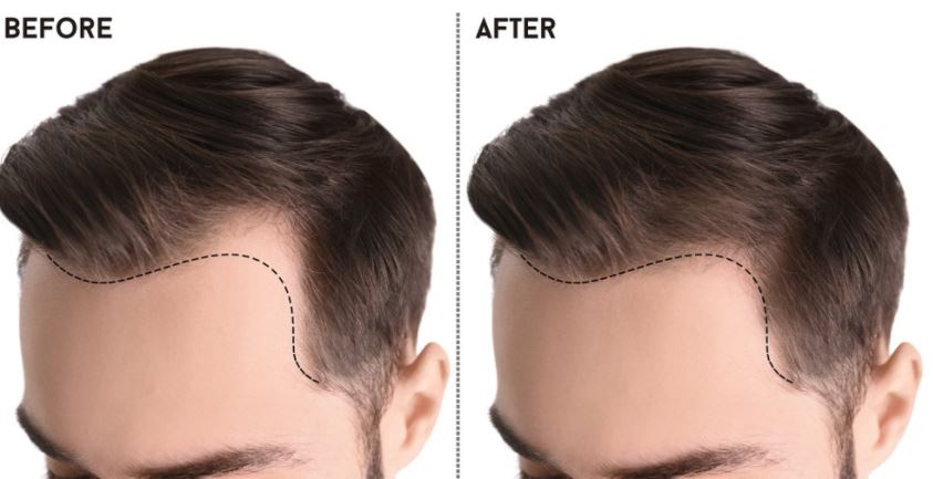 A Review of Hair Transplant Turkey