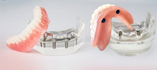 Essential Things You Need to Know About Partial Denture Implants
