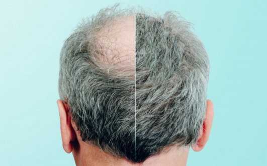 7 Totally BS Laser Hair Caps Myths: Time to burst them