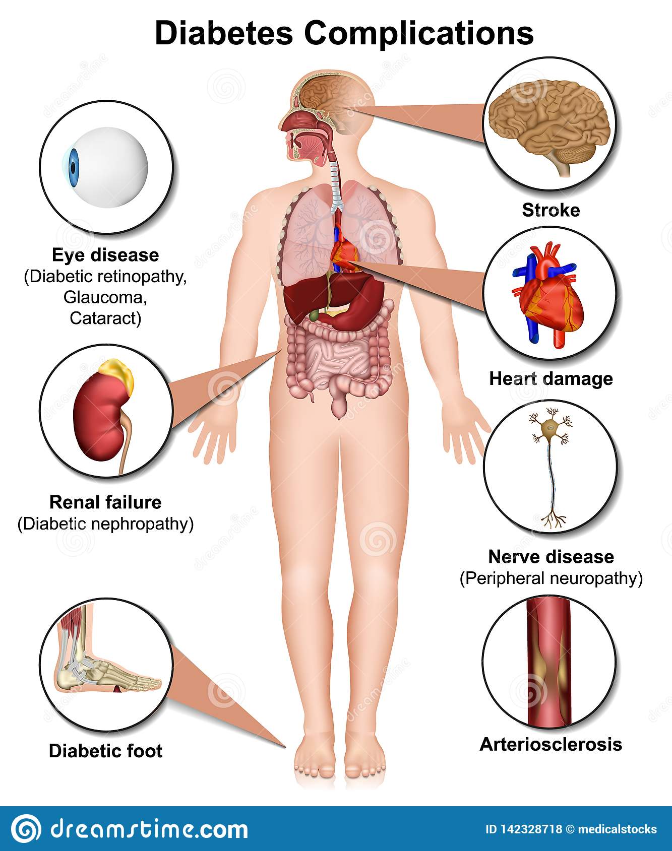 What Are The Complications Of Diabetes Zzoomit