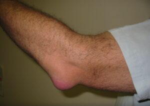 Best Essential Oils And Home Remedies To Stop Bursitis