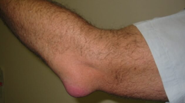 Best Essential Oils And Home Remedies To Stop Bursitis