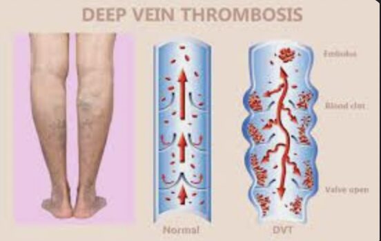 Deep Vein Thrombosis