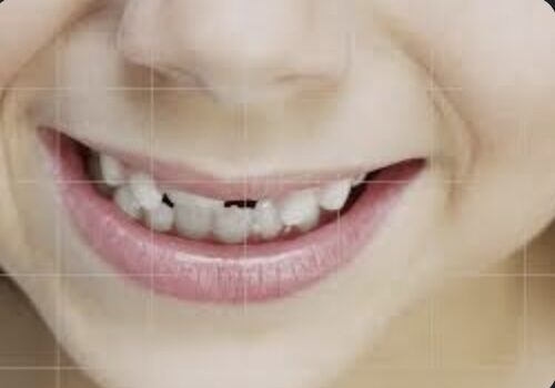 How to Prevent and Treat Tooth Decay