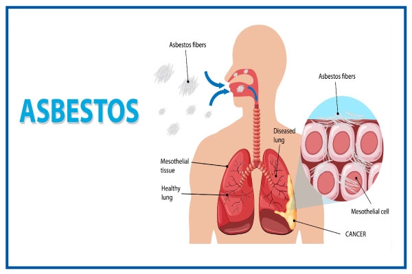 7 Signs of Asbestos Exposure to Be Wary Of