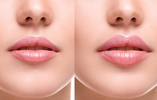 How Long Do Lip Fillers Last In Dubai?